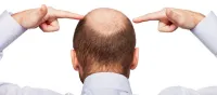XL HAIR – Bước đột phá trong trị rụng tóc, hói đầu